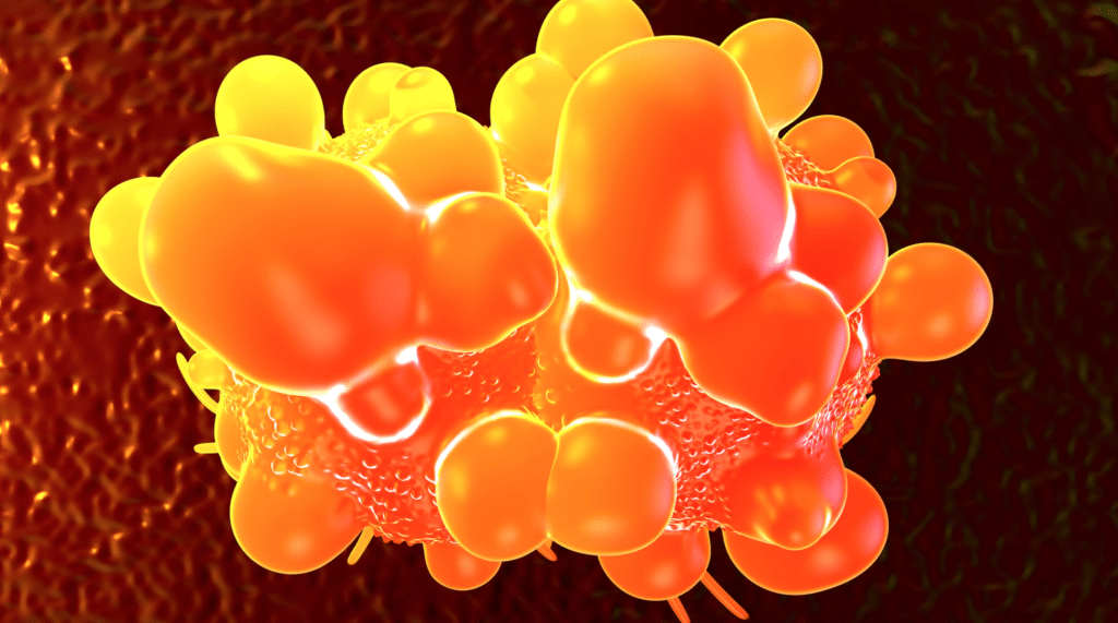 Bowel cancer is a malignant growth that originates in the cells lining the large intestine, which plays a vital role in the digestion and absorption of nutrients. It typically starts as a benign growth known as a polyp, which, over time, can undergo malignant transformation if not detected and treated. These polyps can be categorized into two main types: