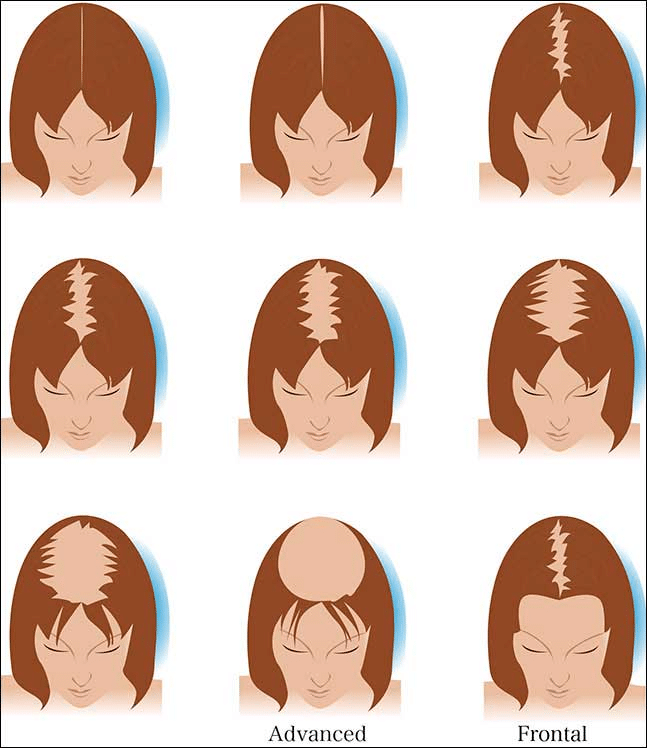 The Hair Transplant Procedures