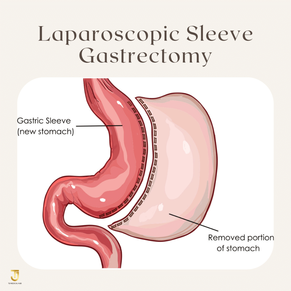 Laparoscopic Sleeve Gastrectomy