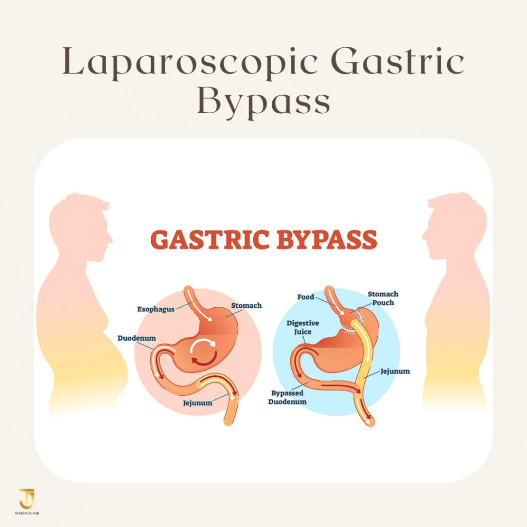 Laparoscopic Gastric Bypass