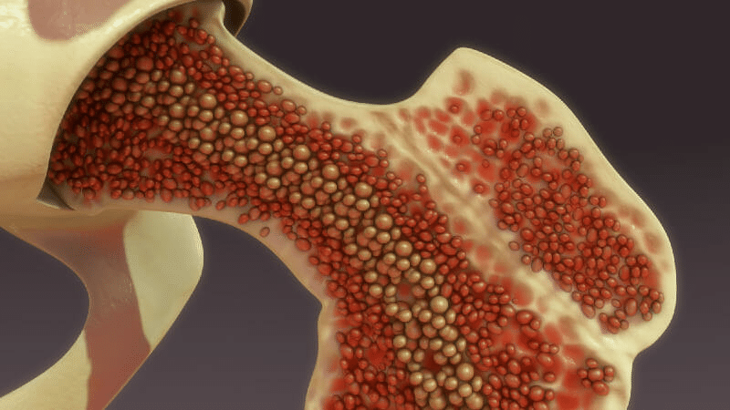 Bone marrow transplant surgery costs: how much is the surgery?