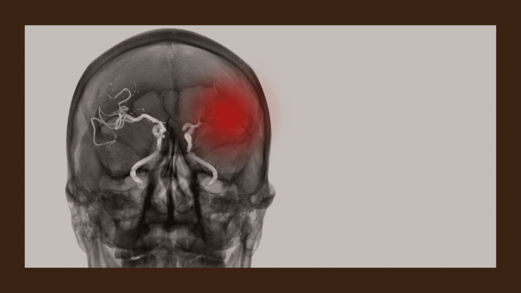 Stroke