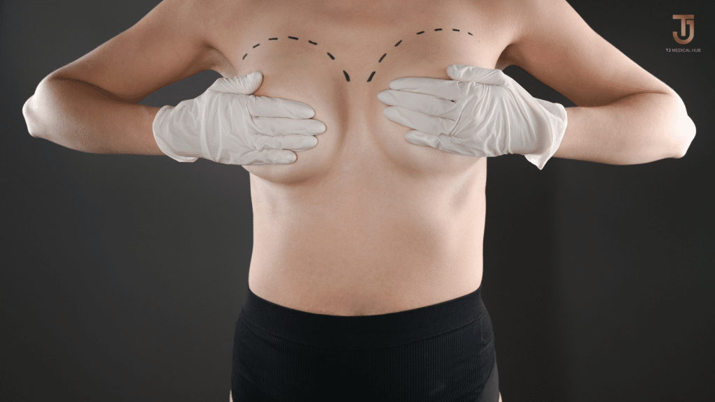 Breast Augmentation