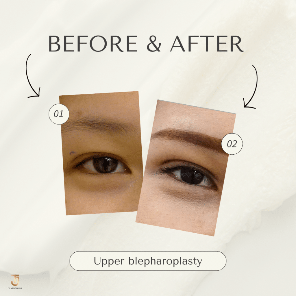 Upper blepharoplasty