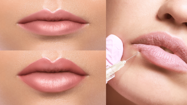 Lip Lift
vs
Lip Filler