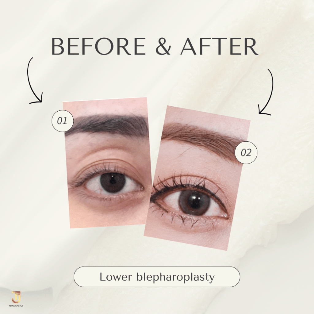 Lower blepharoplasty