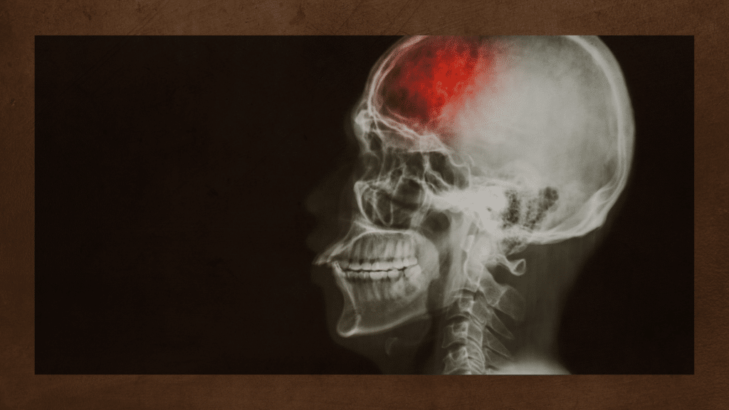 Stroke