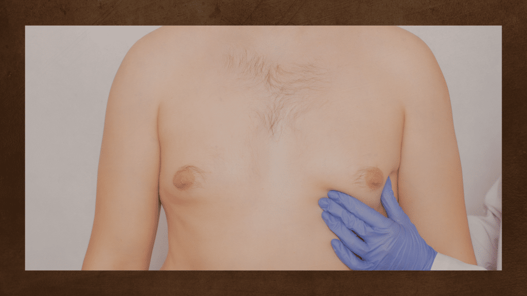 Gynecomastia