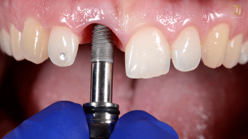 Dental implants in Thailand