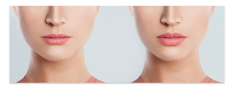 Lip Filler in Thailand