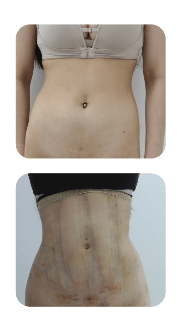 Liposuction Before & After
